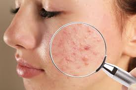 decoding acne types causes and