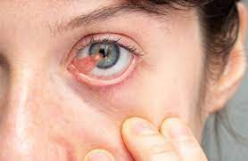 5 serious causes of red eyes luis c