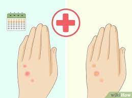 how to treat bed bug bites 12 steps