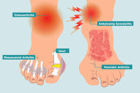 Foot is singular and feet is plural. Arthritis In Your Feet Causes Symptoms And Treatment