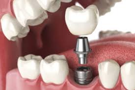 implant dentar empire dental