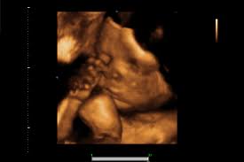 Ultraschall in 3d erlaubt lebensechte bilder. 3d 4d Ultraschall Frauenarztin Dr Med Christiane Von Holst