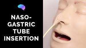 nasogastric ng insertion osce