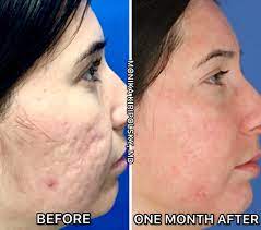 acne scarring dr kiripolsky