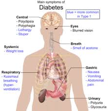 Type 1 Diabetes Wikipedia