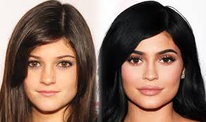 Kylie jenner before plastic surgery since kylie is just 23, she could not get a cosmetic procedure or plastic surgery done without parental consent. Kylie Jenner 2017 Has Kardashian S Half Sister Said To Be Pregnant Had Plastic Surgery Express Co Uk