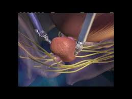Prostate cancer is a common type of cancer in men, according to the mayo clinic. Davinci Robotic Surgery For Prostate Cancer At Rex Youtube