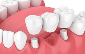 all about dental bridges and it s benifits