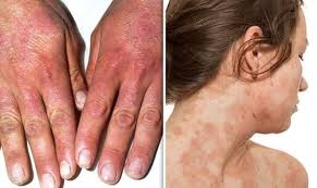 relieve and reduce itchy eczema