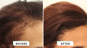 When it's done, it does not. What Getting A Hair Transplant Entails From Cost To Risks How Getting A Hair Transplant Works And How Much It Costs Allure