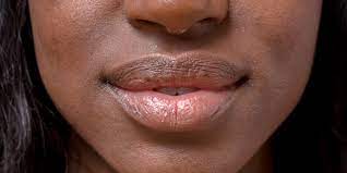 dry lips moisturized during winter