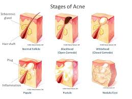 What Is Acne What Causes Acne Stages Of Acne In 2019