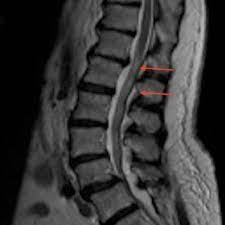 mri lumbar spine showing arthritis and