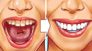 Zahnstein sind feste beläge auf dem zahn. 10 Naturliche Wege Zahnstein Selber Zu Entfernen Youtube