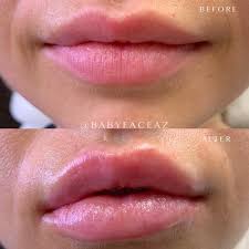 the most y lip fillers in scottsdale