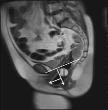 functional disorders of the ano rectal