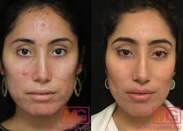 subcision acne scars nyc acne or