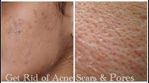 how to remove acne scars pores day