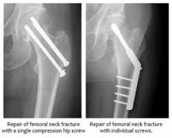 femur fracture surgery singapore hip