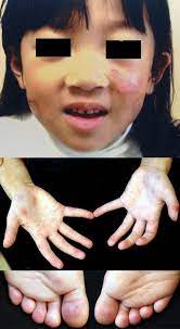 lupus erythematosus malar skin rash and