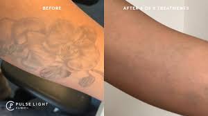 Therefore, it is important to choose a method that is effective and can help it is one of the most common methods of removing tattoos from skin at home. Laser Tattoo Removal London As Seen On Bbc London Pulse Light Clinic London