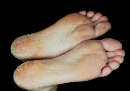 itching of the feet 9 common causes