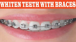 To naturally whiten teeth, you should brush and floss regularly, avoid staining behaviors, and stay away from unproven home remedies. How To Whiten Teeth With Braces At Home Teeth Whitening At Home Youtube