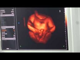 4d color doppler ultrasound