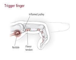 Image result for pics of trigger finger