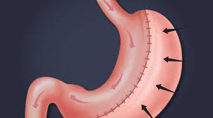 gastric sleeve revision cost success
