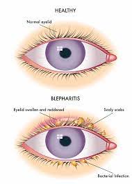 blepharitis new west eyes