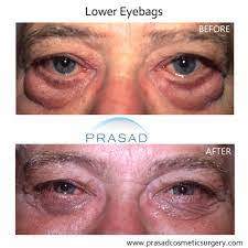 under eye bag surgery prasad cosmetic