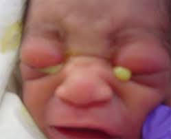 eyes newborn nursery stanford cine