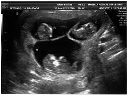 Ultrasound examinations performed early in the 5th week of pregnancy occasionally may fail to while most of these pregnancies are twins, up to 5% are triplets or greater due to the release of pregnancy. A Couple Adopted Triplets One Week Later Doctor Reveals Unexpected News