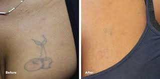 Some designs take modern characters and references and make them look old school. Chest Tattoo Removal Results Case Study Removery