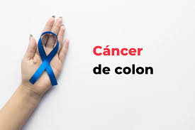 Como se trata el cáncer de colon? Colonoscopia- Hospital Sevilla