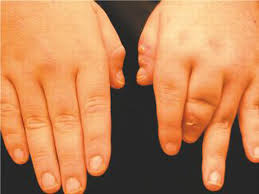 Arthritis is a common condition that causes pain and inflammation in a joint. Psoriatic Arthritis
