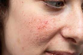 uneven skin tone symptoms treatments