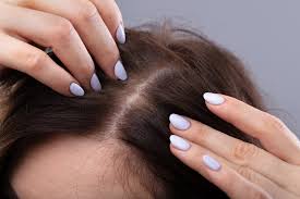 According to the american hair loss association (ahla), birth control pills can cause hair loss, especially in women who are particularly sensitive to hormonal changes. Getting To The Root Of Hair Loss The New York Times