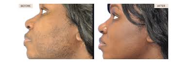 laser hair removal for women thérapie