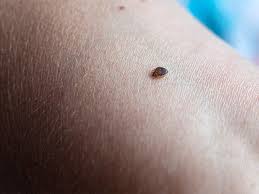 dust mite bites symptoms allergies