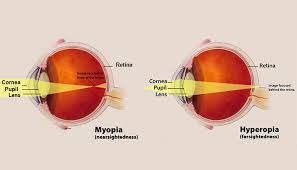 However, some eye surgeons will perform lasik eye surgery on someone lasik eye surgery is used to correct issues concerning vision. Thinking About Getting Laser Eye Surgery Here S Everything You Need To Know Abc News