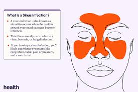 sinus infection sinusitis signs and