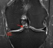 Image result for icd 10 code for bucket handle tear medial meniscus