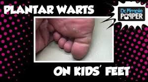 plantar warts on my kids feet you