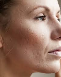 Aside from protecting skin from further uv damage, there are other steps to take to remedy an uneven skin tone on the face. Treat Blotchy Uneven Skin Tone Rao Dermatology