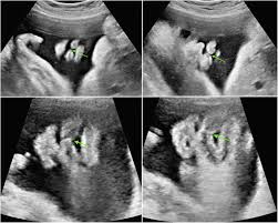 prenatal ultrasonographic diagnosis of