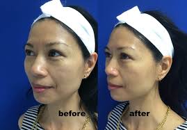 When you read some of the microderm md reviews, one thing that you will see is that this machine has been very effective for all types of skin problems. Hydrafacial Md Before And After Mama In Heels