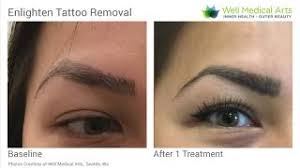 cosmetic tattoo permanent makeup removal