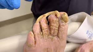 patients overgrown toenails get treated